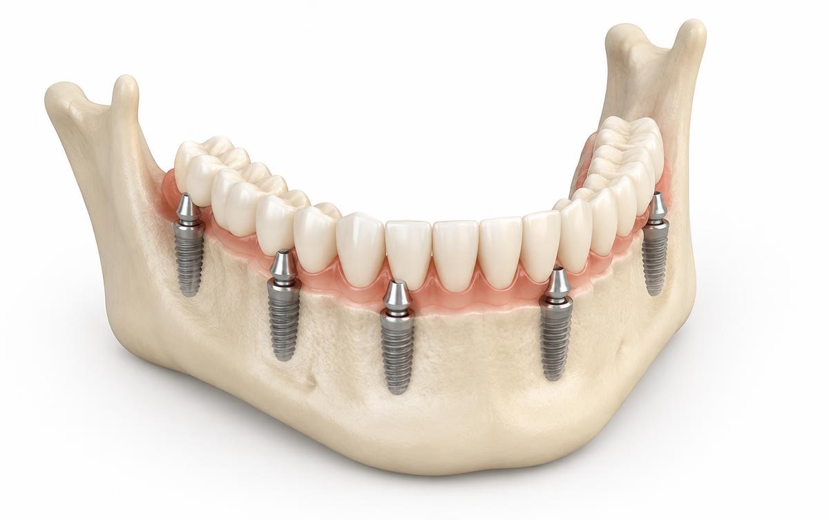Modelo 3D educativo de mandíbula com implantes distribuídos ao longo da arcada